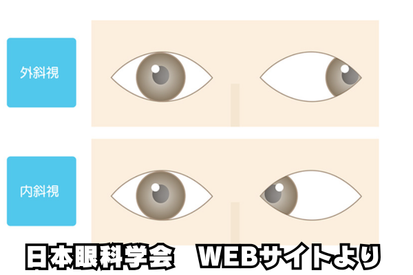 内斜視と外斜視の画像